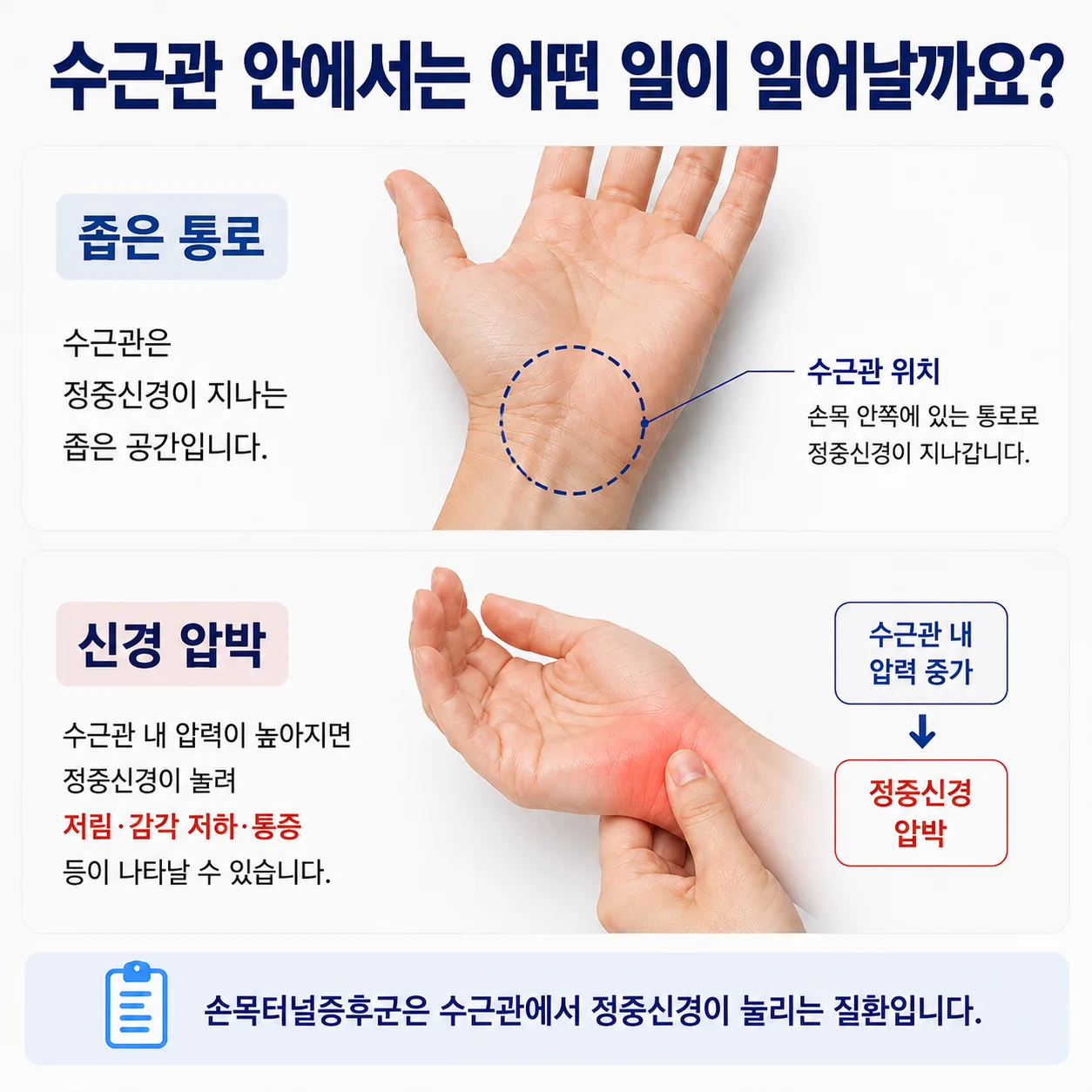 수근관 안에서 일어나는 일 - 좁은 통로와 정중신경 압박